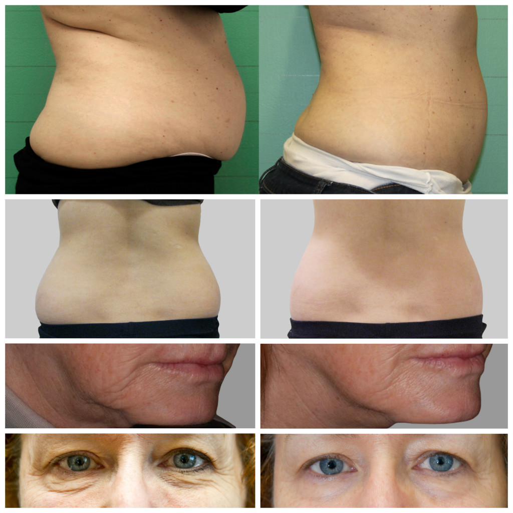 Pretty Please Charlie Exilis Elite review before & after