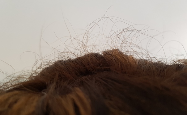 Trichotin Hair Regenesis Review & Hair Loss Update