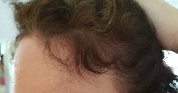 Trichotin Hair Regenesis Review & Hair Loss Update2