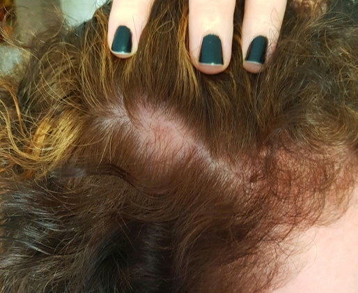 Trichotin Hair Regenesis Review & Hair Loss Update3
