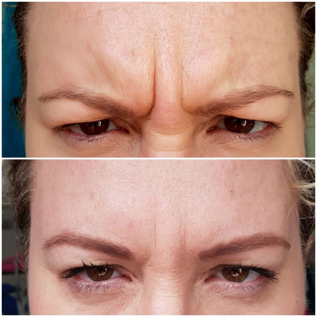 Botox before and after